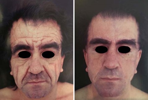 Reducing Wrinkles Through a Facelift