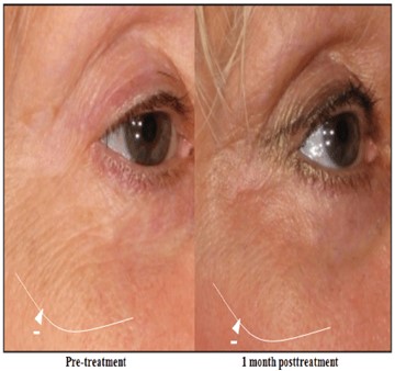 Reducing Wrinkles Using Laser Resurfacing