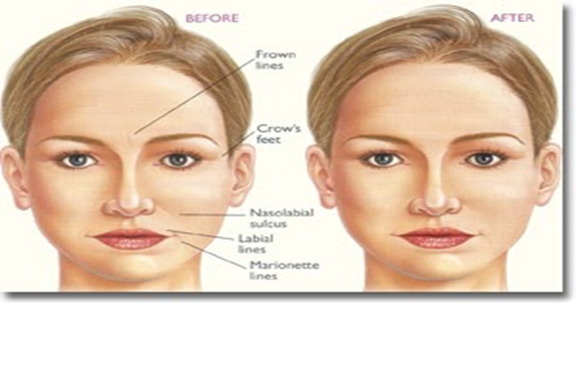 Reducing Wrinkles Tips to Try First